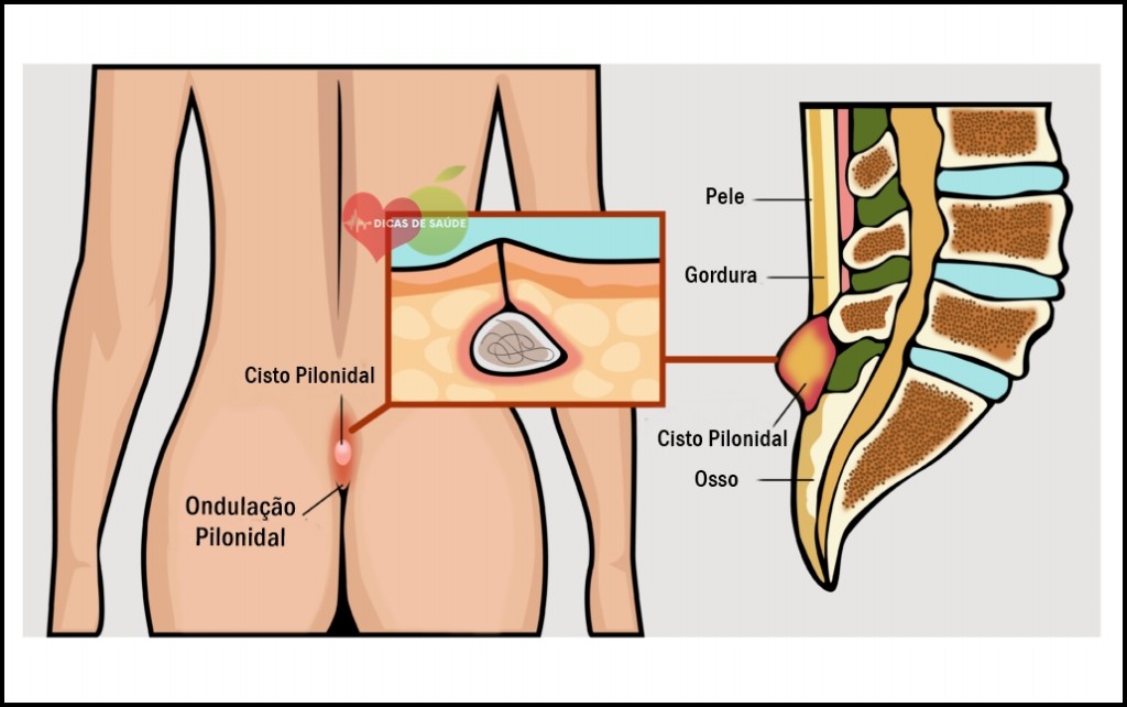 Cisto Pilonidal - O que é, Causas, Sintomas e Tratamentos 1 | Dicas de Saúde
