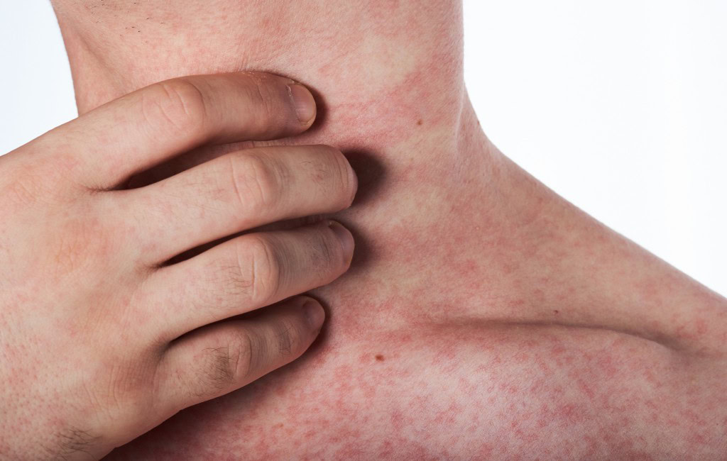 alergia na pele-1 | Dicas de Saúde Alergia na Pele
