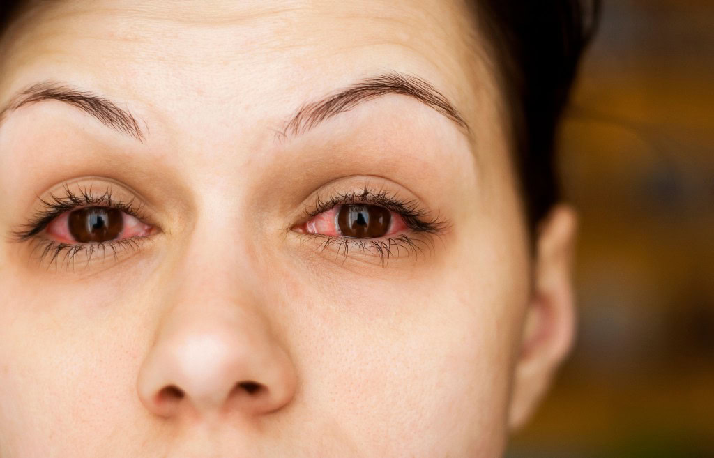 alergia ocular | Dicas de Saúde alergia ocular