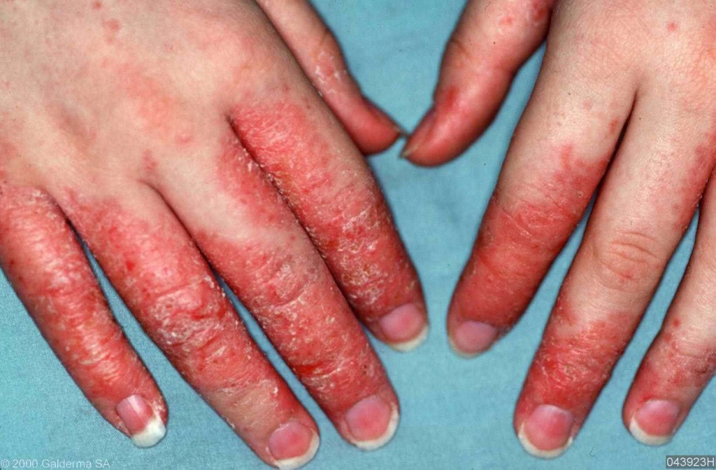 Remédios Caseiros Para Tratar Eczema | Dicas de Saúde
