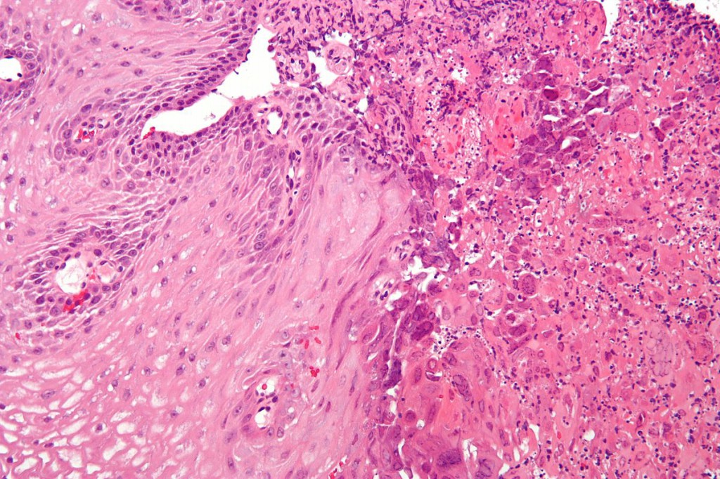 Esofagite eosinofílica | Dicas de Saúde