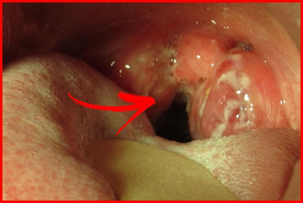 garganta com infeccao | Dicas de Saúde garganta com infeccao