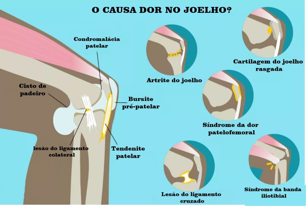 causas da dor no joelho | Dicas de Saúde causas da dor no joelho