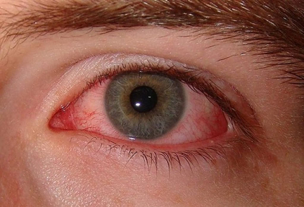 Xeroftalmia - Causas, Sintomas e Tratamentos | Dicas de Saúde