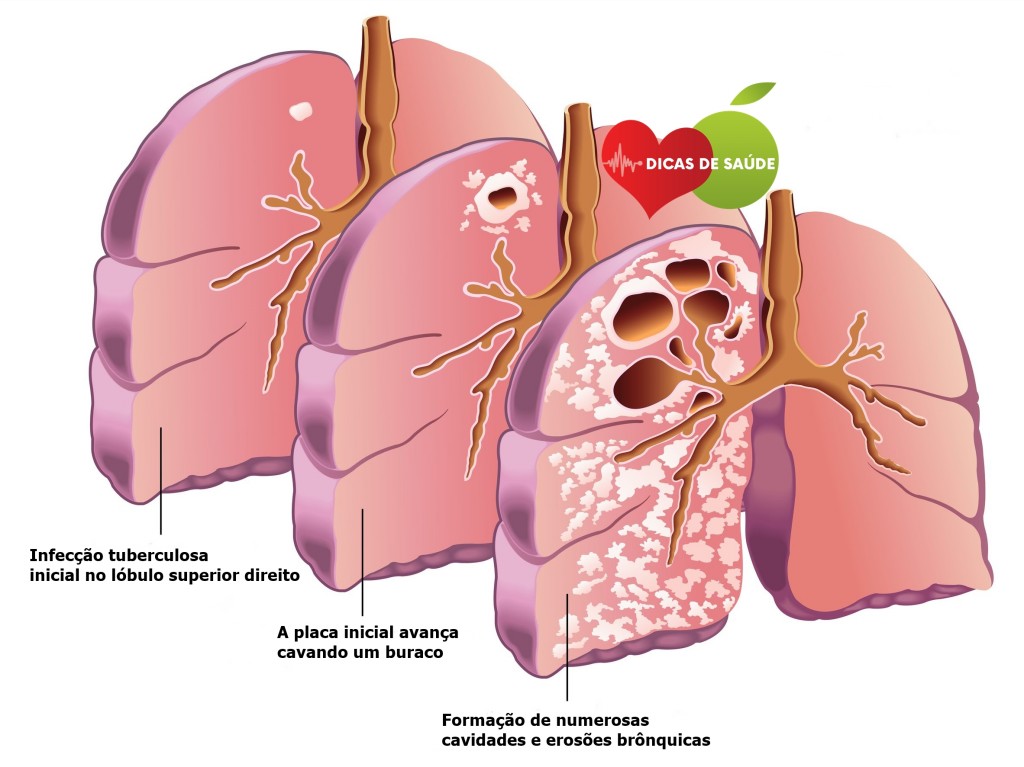 Sintomas da Tuberculose | Dicas de Saúde Sintomas da Tuberculose