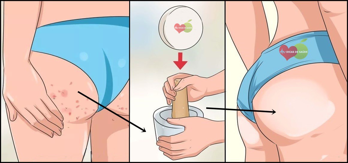 as 3 dicas de como eliminar as acnes do bumbum-3 | Dicas de Saúde