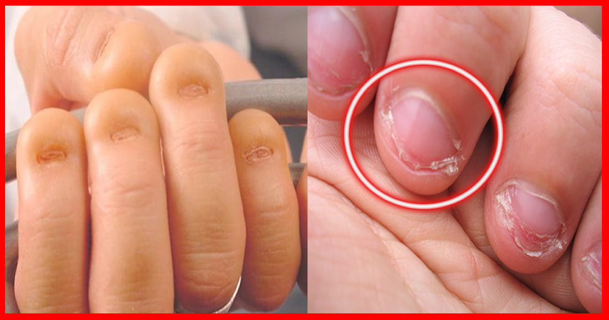 Roer as Unhas - Como se Livrar Para SEMPRE em poucos dias! | Dicas de Saúde