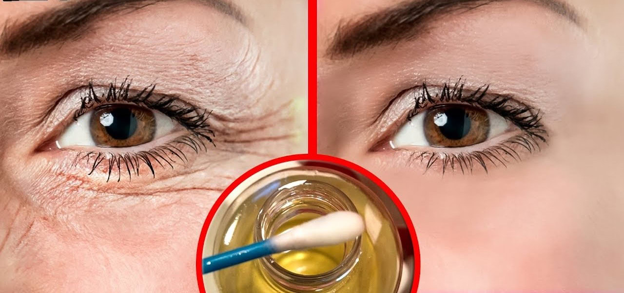 rugas ao redor dos olhos | Dicas de Saúde