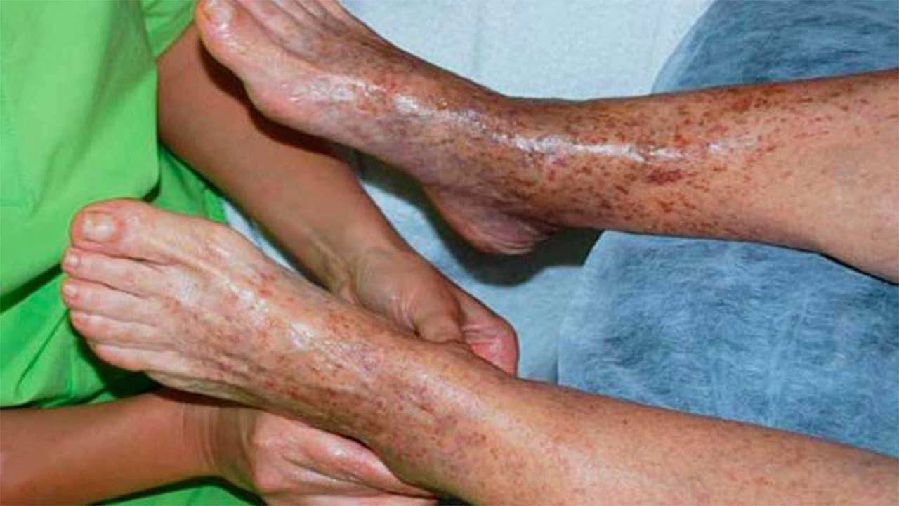 Como acabar com a ma circulaçao | Dicas de Saúde Como acabar com a ma circulaçao