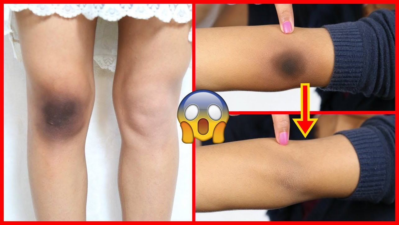 maneiras para clarear manchas escuras na pele | Dicas de Saúde maneiras para clarear manchas escuras na pele