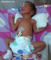 Respiratory Distress Syndrome in Newborn and Surfactant Therapy