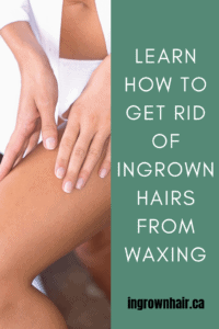 What Causes Ingrown Hairs Ingrown Hair Solutions