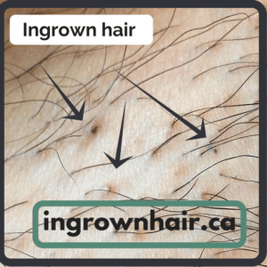 What Causes Ingrown Hairs Ingrown Hair Solutions
