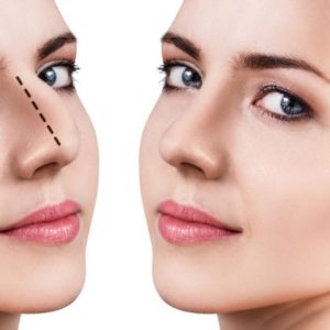 تجميل الانف بالليزر في تركيا أحدث التقنيات 2021 Jawad Medical