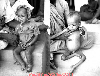 Child of Kwashiorkor and Marasmus
