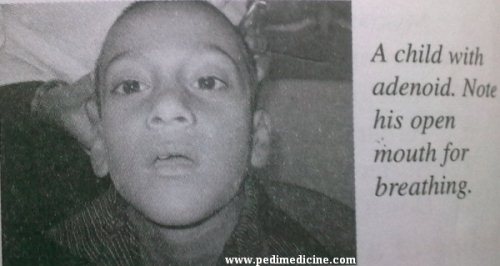 Adenoids facies