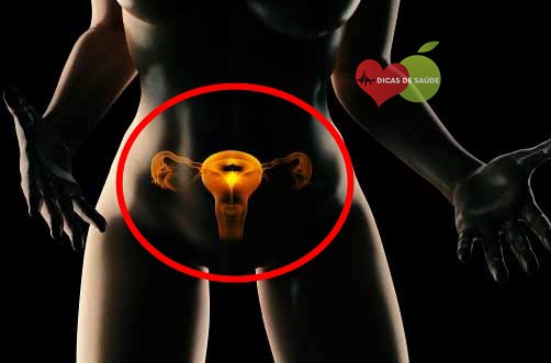 Cervicite | Dicas de Saúde