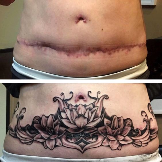 tummy tuck tattoo to cover up scars