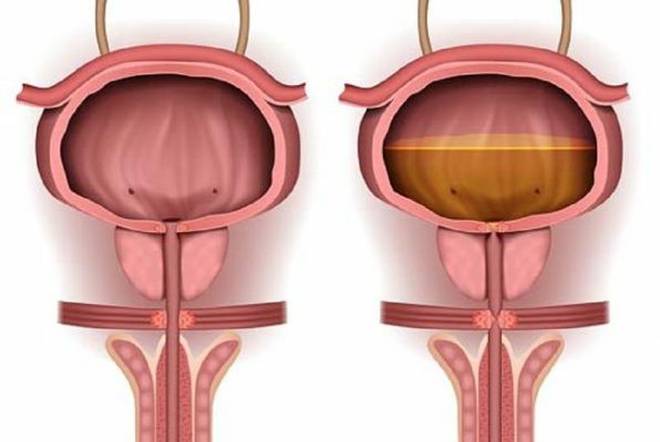 Problemas Provocados Pelo Hábito de Segurar o xixi | Dicas de Saúde