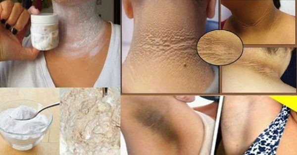 clarear axilas e cotovelos escuros | Dicas de Saúde clarear axilas e cotovelos escuros