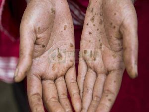 PAC kém chất lượng gây ra những hậu quả nghiêm trọng đến sức khỏe con người