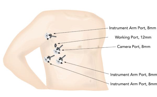 Totally endoscopic robotic ports for atrial fibrillation surgery with or without mitral valve procedures.