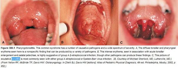bacterial infection in tonsils