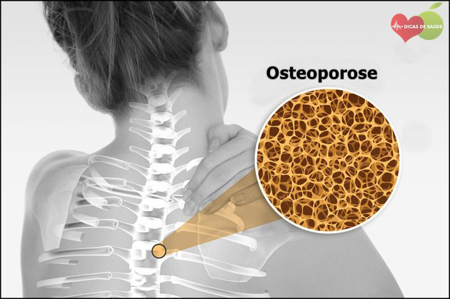 osteoporose | Dicas de Saúde