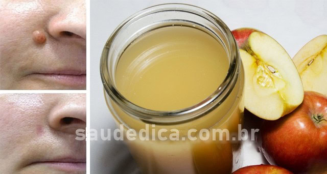 solução para remover fibroma e verruga da pele | Dicas de Saúde solução para remover fibroma e verruga da pele