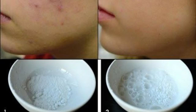 eliminar-acne-com-bicarbonato-de-sodio | Dicas de Saúde