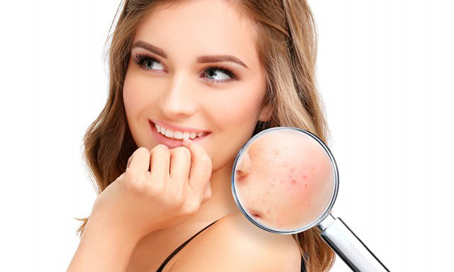 Acne em Adultos Acne em Adultos