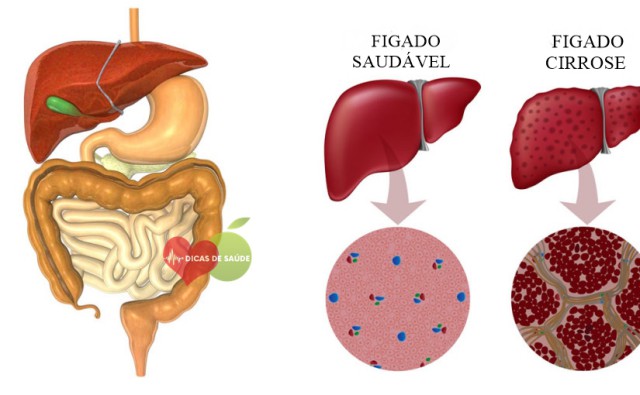 Sintomas da Insuficiência Hepática | Dicas de Saúde Sintomas da Insuficiência Hepática