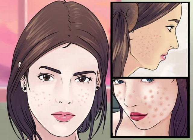 Manchas de Acne | Dicas de Saúde Manchas de Acne