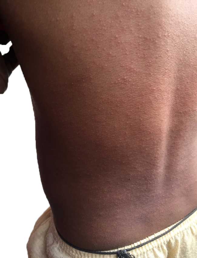 Baby Rashes Causes Treatment and Prevention