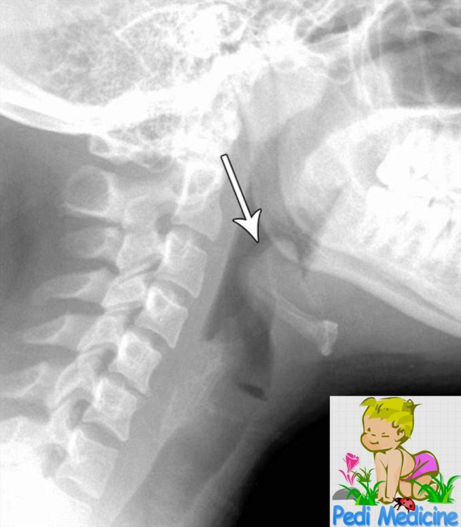 Epiglottis Xray findings