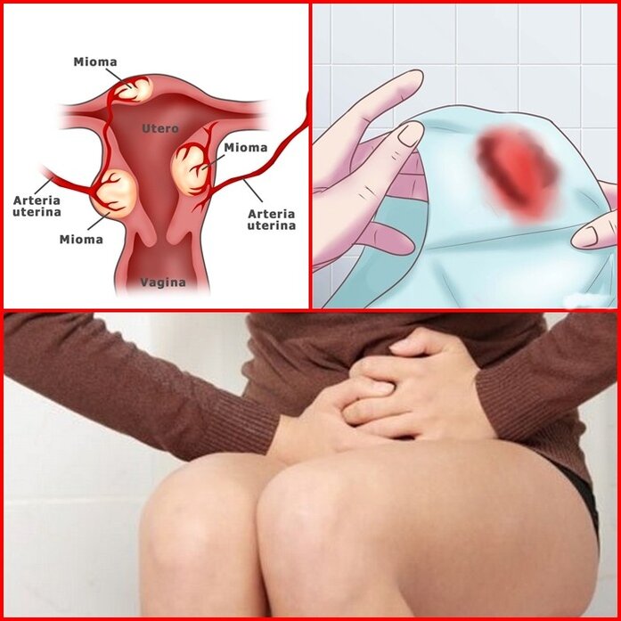 fibroma-uterino-sintomas-tratamentos-e-causas | Dicas de Saúde