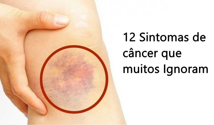 Sintomas de Câncer que Muitos Ignoram | Dicas de Saúde Sintomas de Câncer que Muitos Ignoram