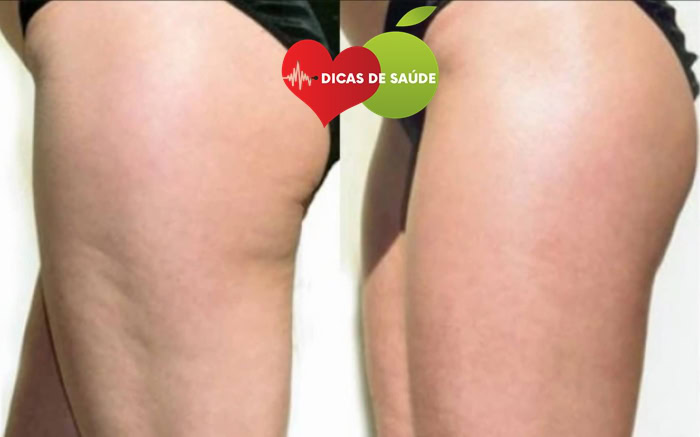 celulite-1 | Dicas de Saúde Dicas Para Eliminar as Celulite