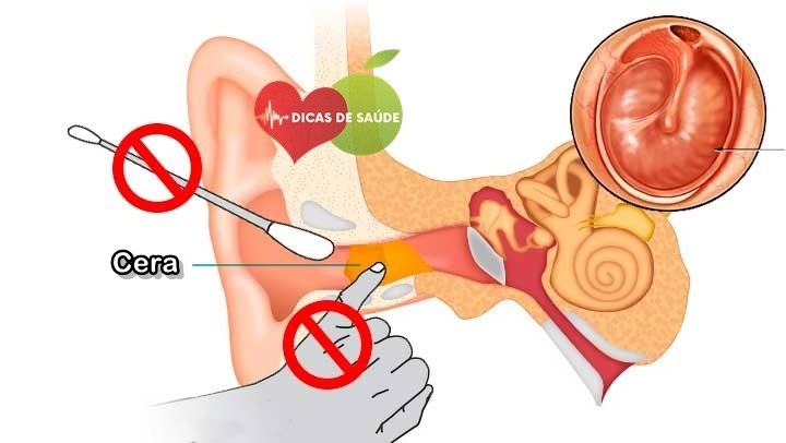 Como Limpar o Ouvido Corretamente | Dicas de Saúde