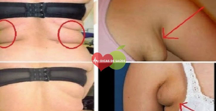 dobras de gordura | Dicas de Saúde
