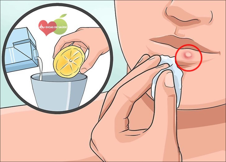tratar afta | Dicas de Saúde