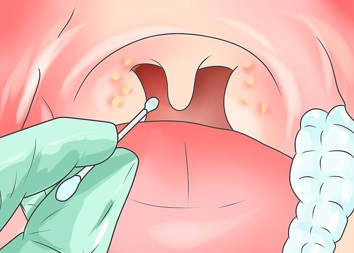 | Dicas de Saúde Faringite