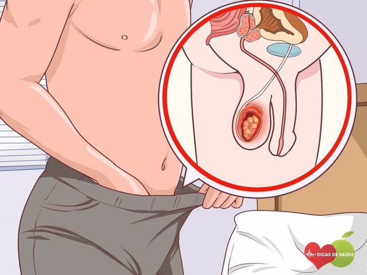 Sintomas do Câncer testicular que não Devemos Ignorar | Dicas de Saúde Sintomas do Câncer testicular que não Devemos Ignorar