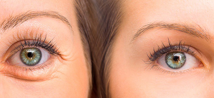 Bolsa nos olhos-1 | Dicas de Saúde Bolsa nos olhos-1