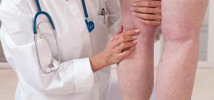 Tromboflebite Tromboflebite