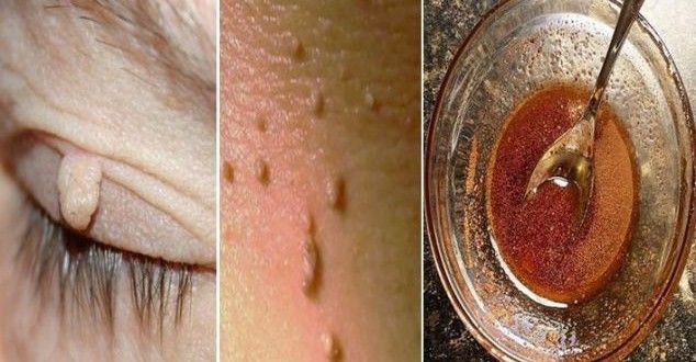remedios caseiros para remover as verrugas | Dicas de Saúde remedios caseiros para remover as verrugas