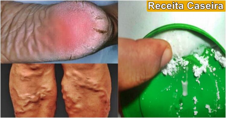 remedio caseiro que cura calcanhares rachados remedio caseiro que cura calcanhares rachados