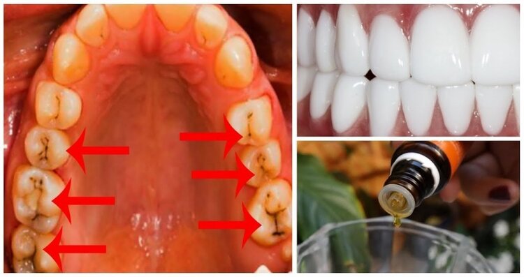 oleo de coco e curcuma para tratar problemas dentarios | Dicas de Saúde oleo de coco e curcuma para tratar problemas dentarios