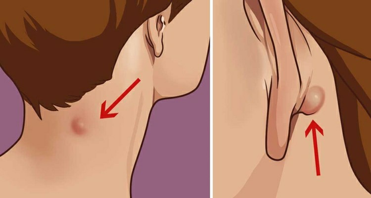 cisto epidermóides-2 | Dicas de Saúde