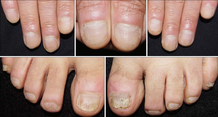 Os 5 Tratamentos Naturais Para Psoríase nas Unhas | Dicas de Saúde